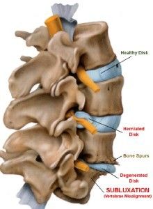 Subluxation illustration
