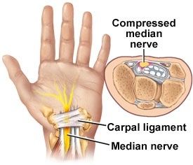carpal tunnel syndrome illustration
