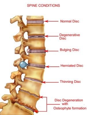 Degenerative Disc Disease illustration