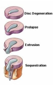 herniated disc stages