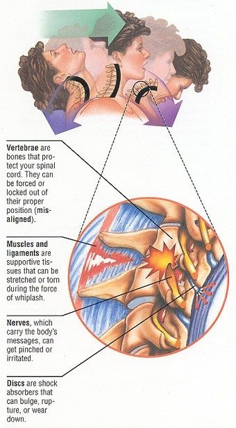whiplash illustration